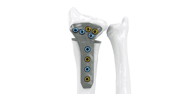 IPS Implants® radius reconstruction