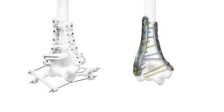 IPS Implants® Distal Humerus Reconstruction